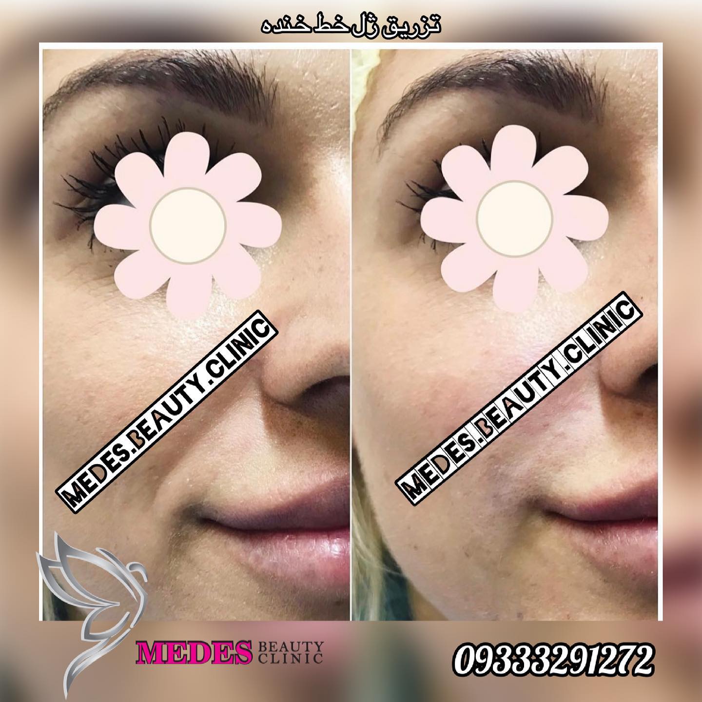 تزریق ژل خط خنده